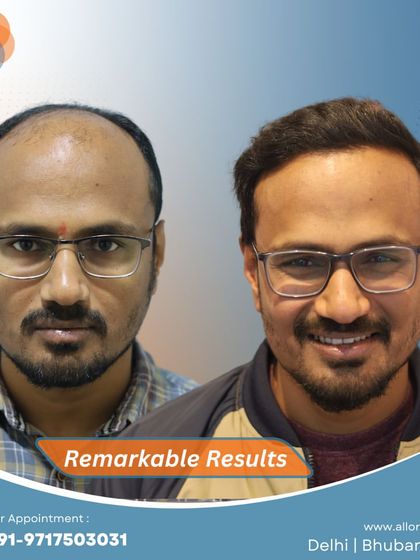 This series shows the meticulous planning phase with hairline marking, the before state, and the remarkable final result. It highlights the importance of a detailed approach to achieve a natural look.