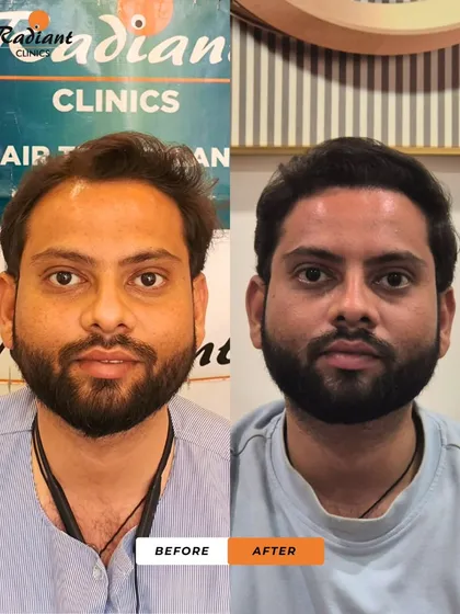 This is the same patient from testimonial video 14. This side-by-side comparison clearly shows the successful restoration of his frontal and mid-scalp regions, resulting in a complete change.