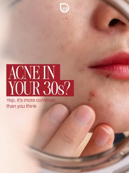 Experiencing acne in your 30s is more common than you might think. I specialize in treating adult acne by addressing its specific triggers.