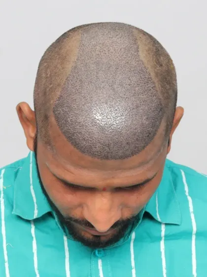 This is what a scalp looks like immediately after the procedure. Each dot is a carefully placed graft, the foundation of a future full head of hair.