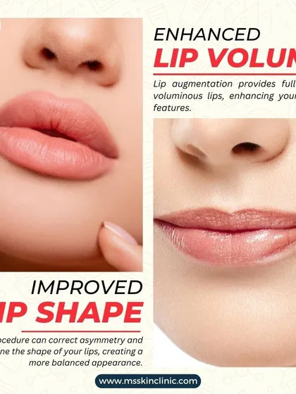 Dermal fillers can do more than just add volume; they can improve lip shape and correct asymmetry. This creates a more balanced and aesthetically pleasing appearance.