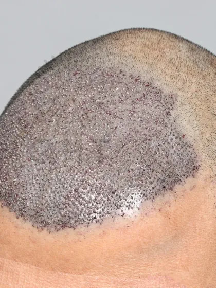 Saying goodbye to baldness. 3500 grafts placed to restore the hairline and mid-scalp.