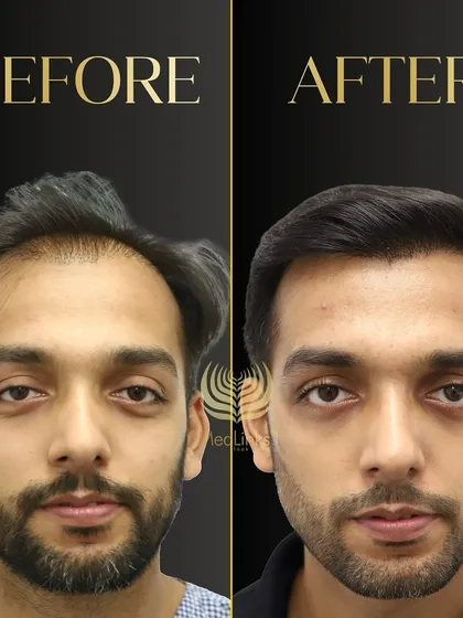 A powerful before and after comparison. We addressed both the receding hairline and the thinning on top to create a comprehensive, natural-looking result that completely transforms his appearance.