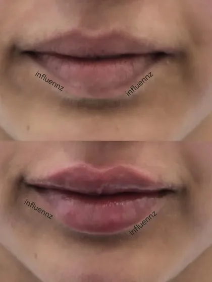 A before and after image demonstrating how lip fillers can add volume and create a more defined cupid's bow for a beautiful, balanced pout.