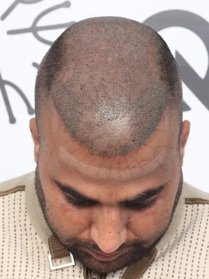 This is what a scalp looks like immediately after the procedure. Each dot is a carefully placed graft, the foundation of a future full head of hair.