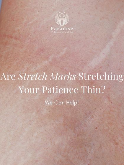 Are stretch marks stretching your patience thin? I offer proven solutions like chemical peels, microdermabrasion, and microneedling to resurface the skin, fade marks, and boost collagen for a smoother appearance.