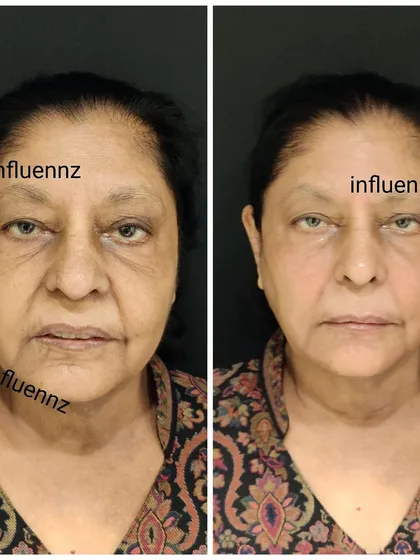 This before and after shows a liquid facelift transformation. This non-surgical treatment uses fillers to restore volume and lift the face, creating a more youthful and refreshed appearance.