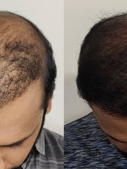 A similar case of diffuse thinning on the crown. The 'after' image demonstrates a significant increase in density and coverage after the hair transplant procedure.