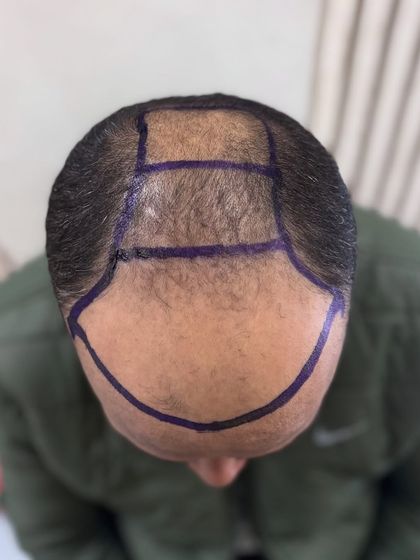 A top-down view of the head with the transplant areas marked for a 5400 graft procedure.