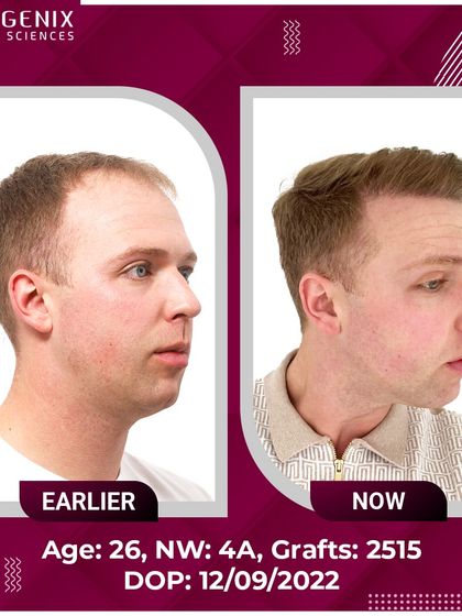 A complete before-and-after set of a 26-year-old patient from the UK, showcasing a restored hairline and youthful appearance.