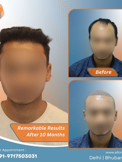 These images show the remarkable results after 10 months, including the planning stage. It's a clear demonstration of how careful planning leads to a successful and natural-looking outcome.