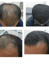 Hair Loss Treatment