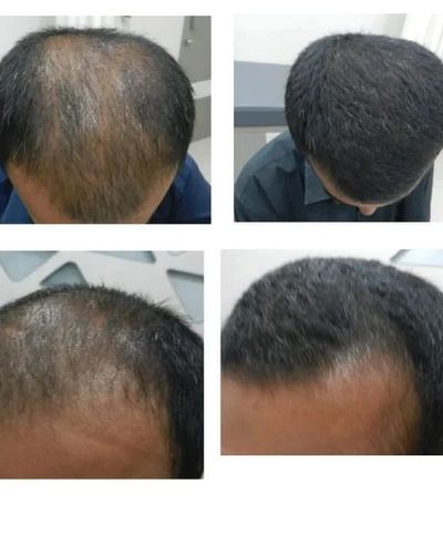 Hair Loss Treatment