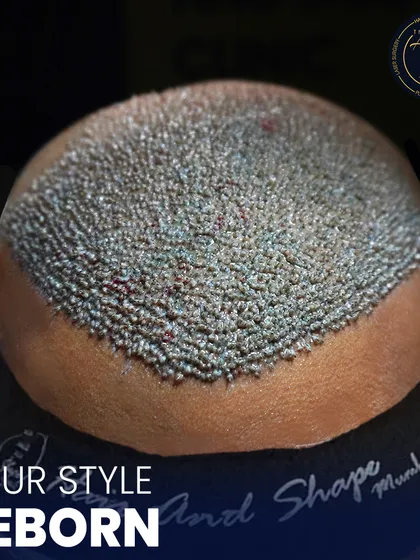 This is what a high-density hair transplant looks like immediately after the procedure. Each follicle is carefully placed at the correct angle and depth to ensure the new hairline grows in a way that is dense, natural, and permanent.