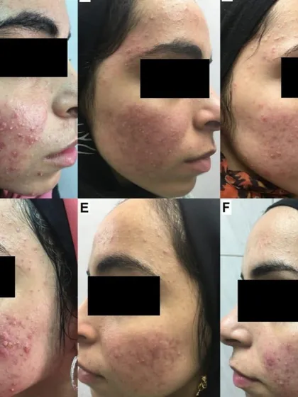 This progression shows how I treat inflammatory acne and prevent future scarring. By managing breakouts effectively, we can minimize long-term damage and work towards clear, healthy skin.