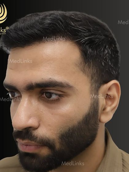 The final result from the side, showing a natural and dense hairline.