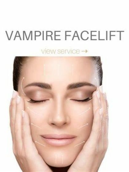 The Vampire Facelift is a service I offer for non-surgical skin rejuvenation. The arrows indicate the lifting and tightening effect that is achieved by stimulating collagen production with PRP.