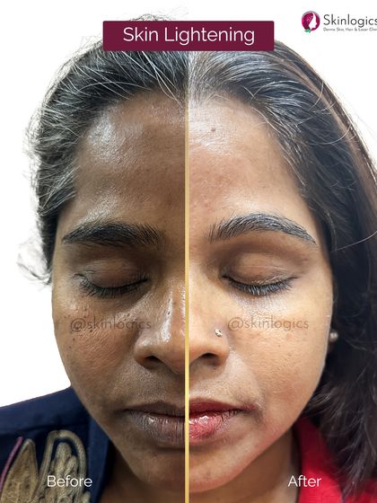 A split-screen view of the patient from image 37, directly comparing the 'before' and 'after' stages of the skin lightening treatment to highlight the effectiveness of the procedure.