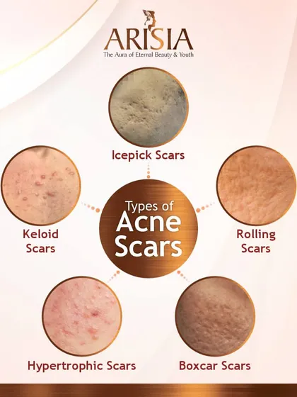 Understanding the type of acne scar you have, whether it's icepick, rolling, or boxcar, is the first step. Each type requires a different treatment approach. I use this knowledge to build a precise, effective plan for you, combining technologies to achieve the best possible skin resurfacing.