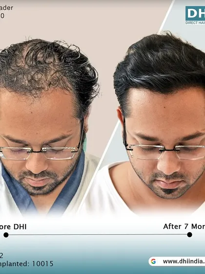A before and after of a 32-year-old client 7 months after receiving an incredible 10,015 implanted hairs. The transformation is remarkable, with a restored hairline and excellent density.