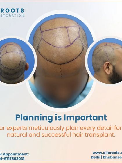 Meticulous planning is the most important part of a successful hair transplant. I map out every detail of the procedure, from donor graft selection to recipient site placement, to ensure the outcome is both natural and sustainable for the long term.