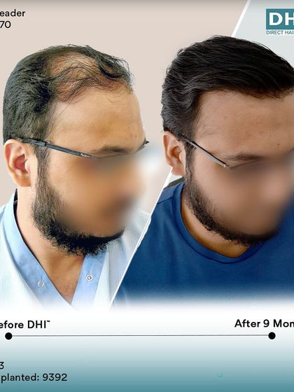 A side-profile view of the same client's 9-month transformation. The restored hairline and temple points create a sharp, defined look, showcasing the artistic precision of our DHI surgeons.