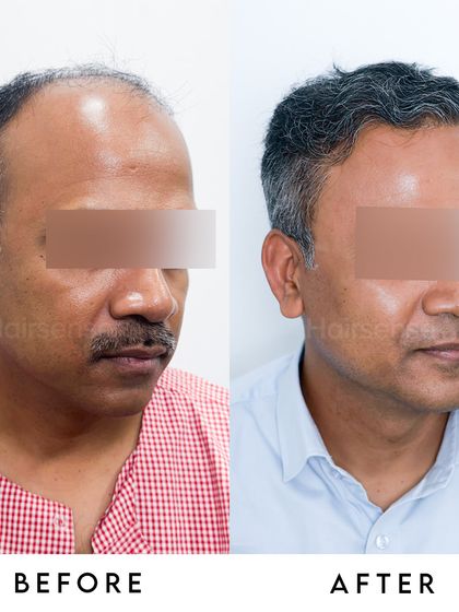 Notice the subtle, natural wave in the restored hair, which we achieve by carefully placing grafts to match the patient's original hair pattern.