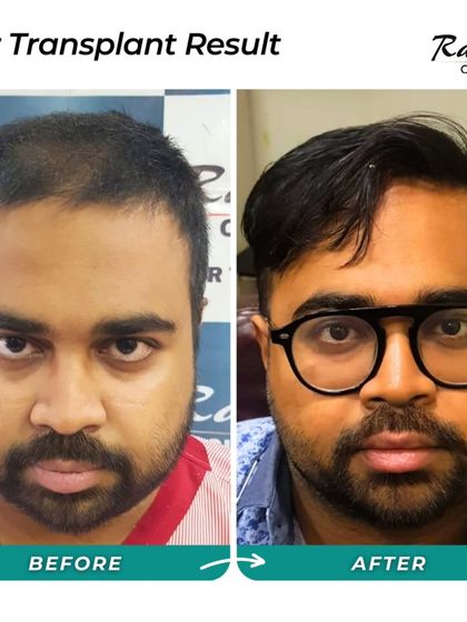 This is the before-and-after for the patient in testimonial video 31, who came for a corrective surgery. The result is a complete transformation from a patchy, unnatural look to a full, healthy head of hair.