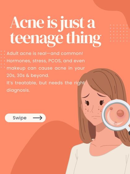 It's a common myth that acne is only for teenagers. Adult acne is very real and can be caused by hormones, stress, or PCOS. The good news is that it's treatable with the right diagnosis and a consistent plan.