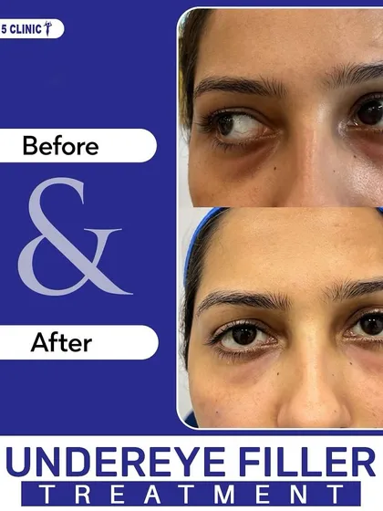 Tired-looking eyes are a common concern we address. This image shows the immediate, rejuvenating effect of our under-eye filler treatment, which reduces hollowness and dark circles for a brighter, more rested look.