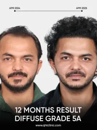 Hair Transplant Surgery