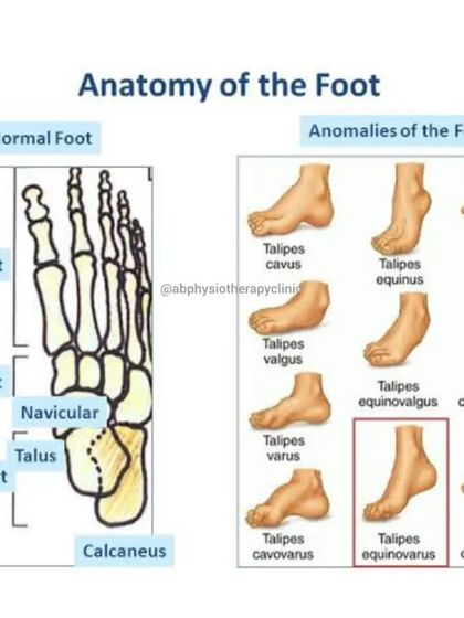 An overview of the foot's anatomy and common anomalies. Understanding your foot structure is the first step in treating conditions like flat feet or high arches.