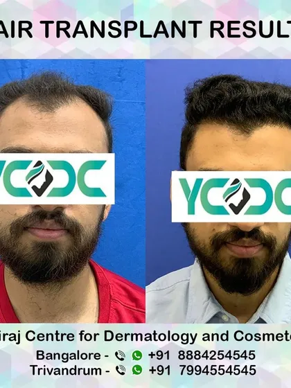 This front-on comparison highlights the dramatic change in appearance, with a fuller beard complementing the restored hairline for a complete look.