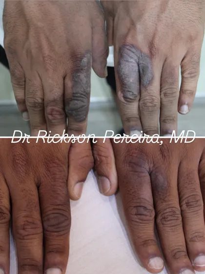 After two years of struggling with chronic hand eczema that interfered with daily life, this patient found relief. We used a targeted combination of Alma Hybrid laser and topical therapy to resolve the inflammation and itching completely in two months, avoiding the need for systemic medications.
