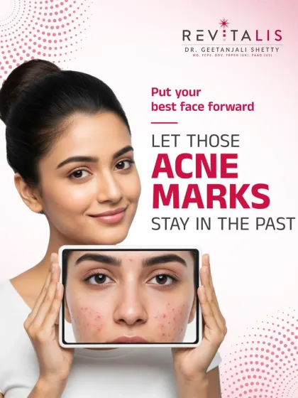 Putting Acne Marks in the Past. This visual represents the goal of my acne treatment programs: moving beyond active breakouts to achieve clear skin that lets you put your best face forward.