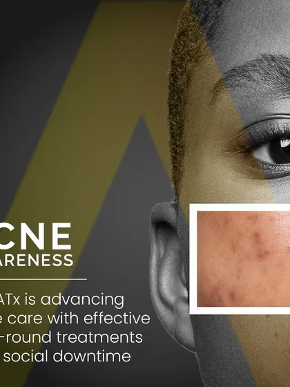 Acne requires year-round awareness and care. AdvaTx is an effective treatment that can be performed any time of year with no social downtime, fitting seamlessly into your life.