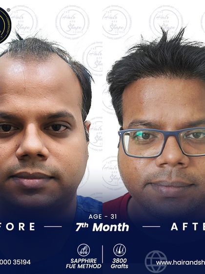 This patient's 7-month result after a 3800-graft Sapphire FUE procedure. The change in his hairline and overall look is a testament to the precision of this technique.
