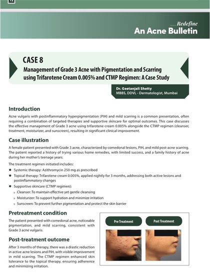 Case Study: Managing Grade 3 Acne. This is a page from a medical bulletin where I authored a case study on treating severe acne with pigmentation and scarring using a combination of therapies, including Trifarotene cream.