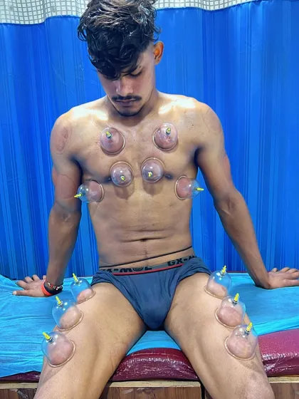 A client undergoing dry cupping therapy on the chest and thighs. This method helps to lift the connective tissue, increase blood flow, and relieve muscle tension.