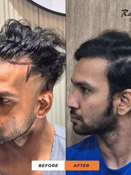 Another angle of the concealed transplant patient. The 'before' shows the pre-drawn hairline, and the 'after' shows the final, natural-looking result that blends perfectly with his long hair.