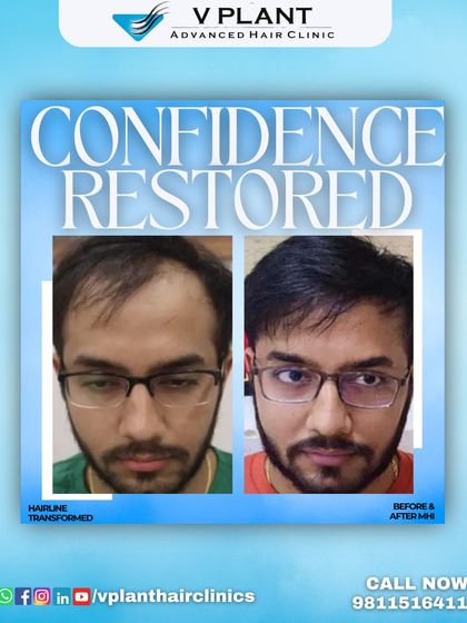 Confidence restored. This before-and-after image focuses on the transformation of the hairline after our MHI procedure, showing a fuller, more defined, and natural look.