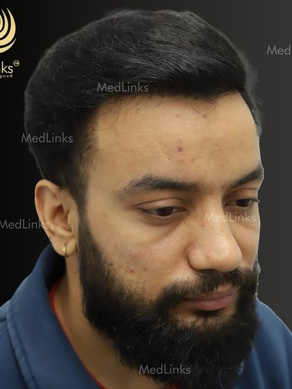 The final result, with a dense and natural head of hair that completely changes his appearance.