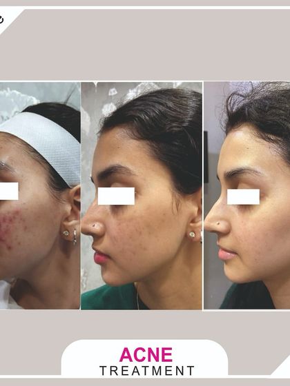 A profile view showing the successful treatment of cheek acne, resulting in smoother skin and fewer breakouts.