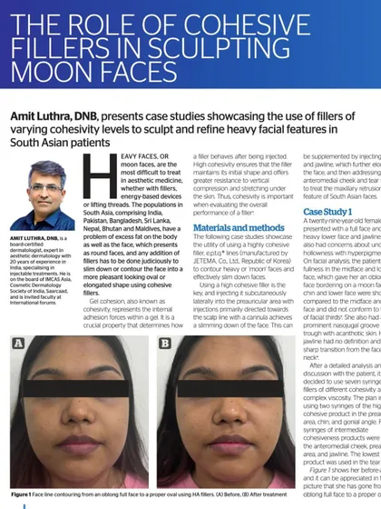 In this published article, I discuss my techniques for using cohesive fillers to sculpt and refine facial features, particularly for South Asian patients. This showcases the science behind achieving a balanced, oval face shape.