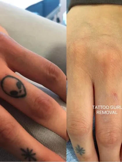Even small tattoos in delicate areas like the finger can be removed. This shows a before and after of a small alien head design, demonstrating the precision of my laser removal work.