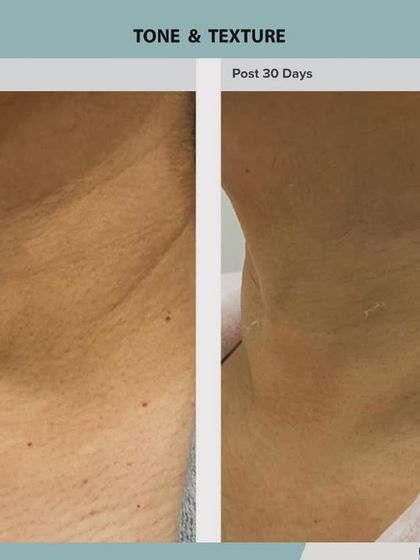 Advanced Laser Rejuvenation: The ADVA Tx Advantage photo 5