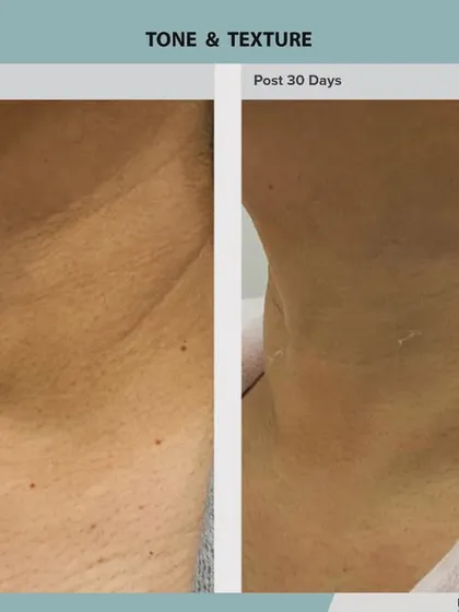 This close-up of the neck shows a remarkable smoothing of horizontal lines and crepey texture. ADVA Tx is exceptionally effective for rejuvenating the delicate skin on the neck.