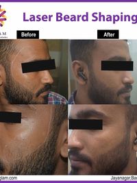 Laser Hair Reduction