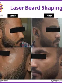 Laser Hair Reduction