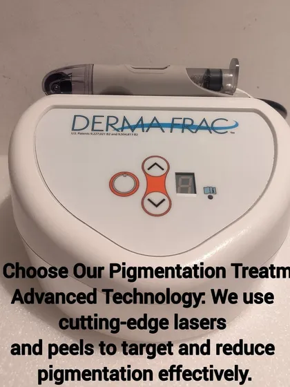 This is the advanced Dermafrac system we use for many of our skin rejuvenation treatments. This US FDA-approved technology combines microneedling with the simultaneous infusion of targeted serums, allowing us to effectively treat pigmentation, acne scars, and signs of aging.